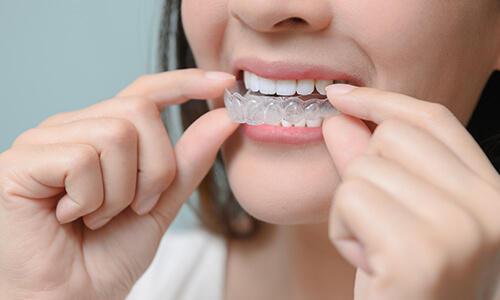 Woman putting clear teeth aligners in